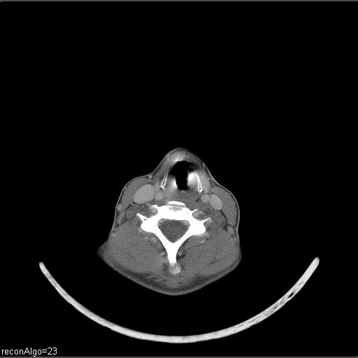 Carcinoma of the maxillary antrum (Radiopaedia 53805-59888 Axial C+ delayed 17).jpg
