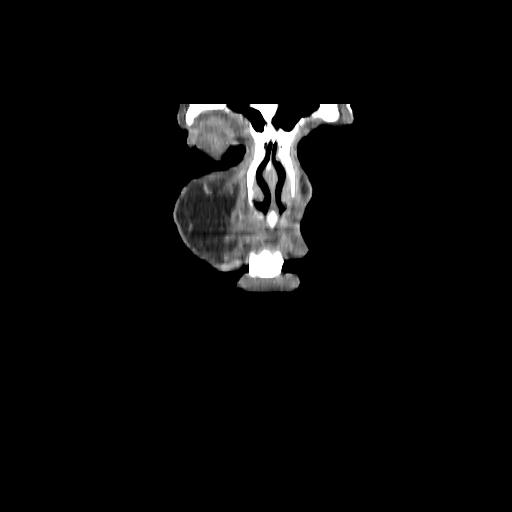 Carcinoma of the maxillary antrum (Radiopaedia 53805-59888 Coronal C+ delayed 7).jpg