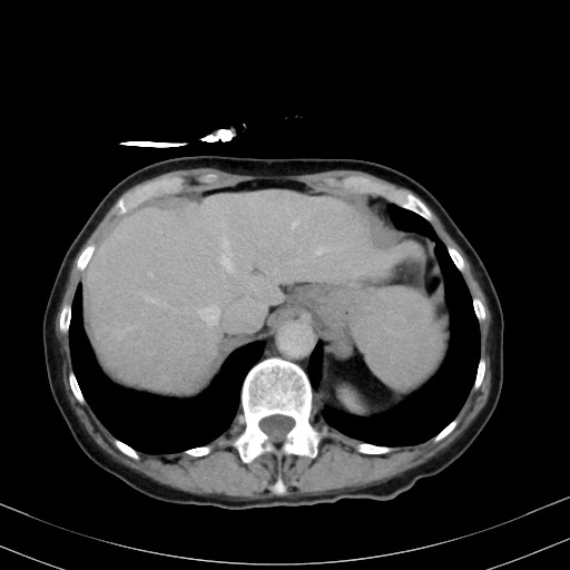 Carcinosarcoma (Radiopaedia 70401-80503 A 11).jpg