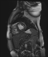 Cardiac amyloidosis (Radiopaedia 51404-57150 Sagittal CINE SSFP 141).jpg