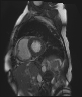 Cardiac amyloidosis (Radiopaedia 51404-57150 Sagittal CINE SSFP 201).jpg