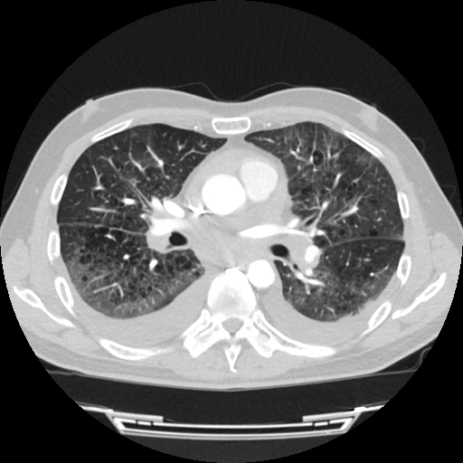 Cardiac tamponade (Radiopaedia 78607-91368 Axial lung window 41).jpg