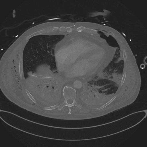 Cardiac trauma (Radiopaedia 32874-33858 Axial bone window 61).jpg