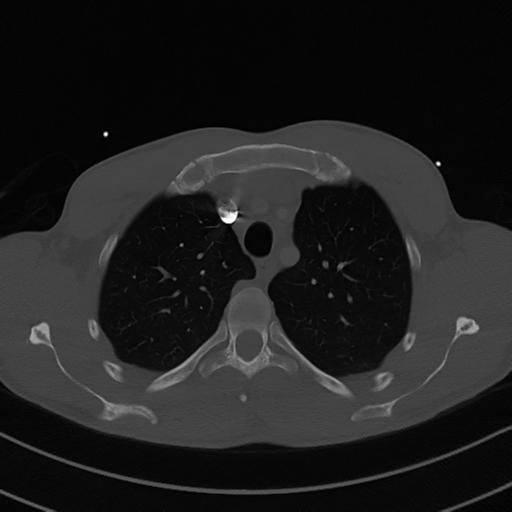 Cardiac tumor - undifferentiated pleomorphic sarcoma (Radiopaedia 45844-50134 Axial bone window 17).png