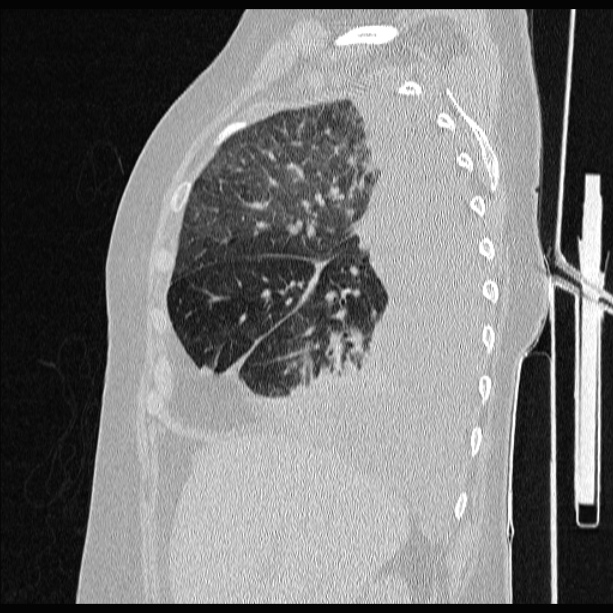 Cardiogenic pulmonary edema (Radiopaedia 29213-29609 Sagittal lung window 28).jpg