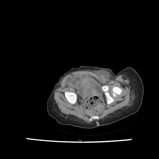 Caroli disease with autosomal recessive polycystic kidney disease (ARPKD) (Radiopaedia 89651-106703 B 210).jpg