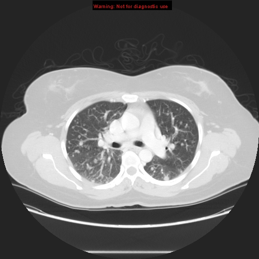 Carotid body tumor with lung metastases (Radiopaedia 9301-48390 Axial lung window 31).jpg