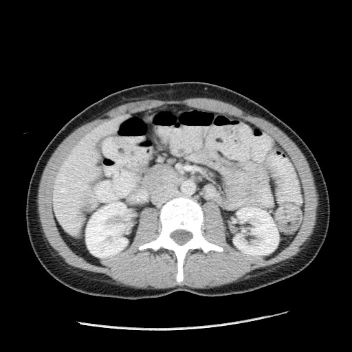 Castleman disease with fibrous pseudotumor in the abdomen (Radiopaedia 77296-89373 A 55).jpg