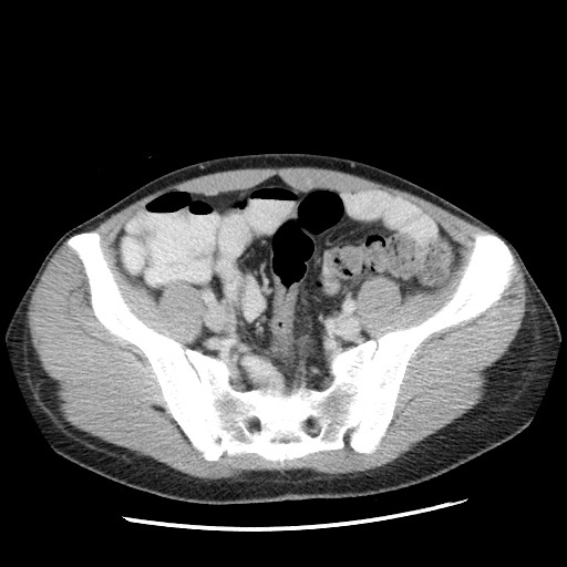 File:Castleman disease with fibrous pseudotumor in the abdomen (Radiopaedia 77296-89373 Axial 48).jpg