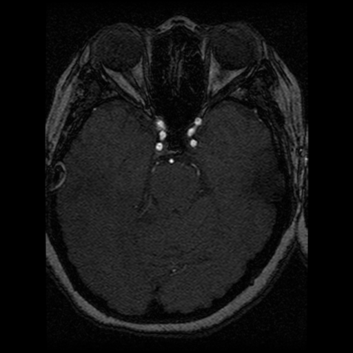 Cavernoma, DVA and right ICA aneurysm (Radiopaedia 33890-35072 E 60).png