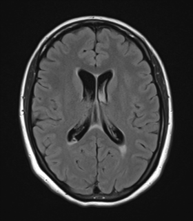 File:Cavernoma with bleed - midbrain (Radiopaedia 54546-60774 Axial FLAIR 18).png