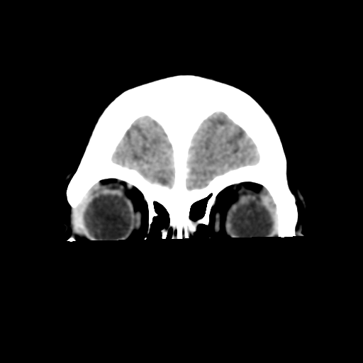 Cavernoma with hemorrhage (Radiopaedia 70755-80931 Coronal non-contrast 10).png
