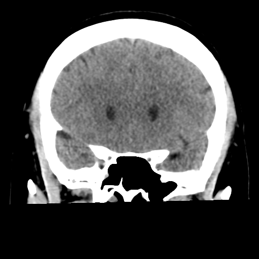 Cavernoma with hemorrhage (Radiopaedia 70755-80931 Coronal non-contrast 22).png