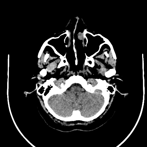 Cavernous hemangioma of the cerebellar falx (Radiopaedia 73025-83723 Axial non-contrast 17).jpg