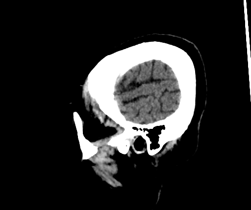 Cavernous hemangioma of the cerebellar falx (Radiopaedia 73025-83723 B 291).jpg