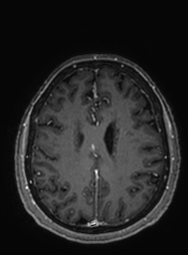 Cavernous hemangioma of the cerebellar falx (Radiopaedia 73025-83724 Axial T1 C+ 108).jpg