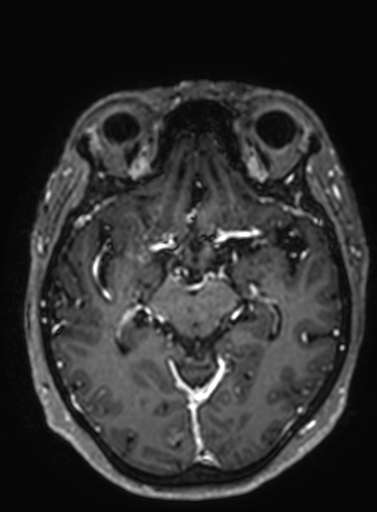 Cavernous hemangioma of the cerebellar falx (Radiopaedia 73025-83724 Axial T1 C+ 195).jpg