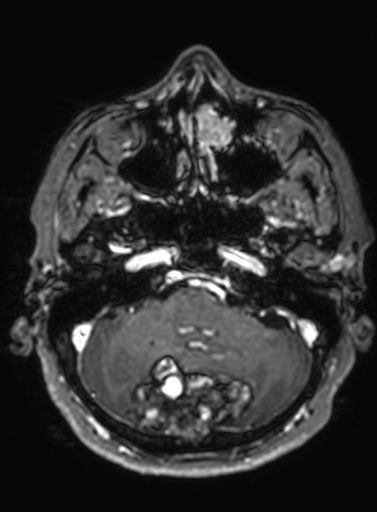 File:Cavernous hemangioma of the cerebellar falx (Radiopaedia 73025-83724 Axial T1 C+ 262).jpg