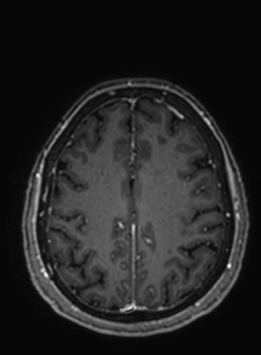 Cavernous hemangioma of the cerebellar falx (Radiopaedia 73025-83724 Axial T1 C+ 98).jpg