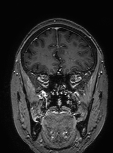 Cavernous hemangioma of the cerebellar falx (Radiopaedia 73025-83724 Coronal T1 C+ 102).jpg