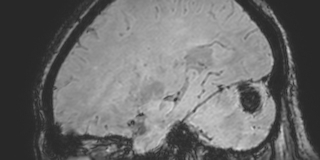 Cavernous hemangioma of the cerebellar falx (Radiopaedia 73025-83724 Sagittal BOLD 140).jpg