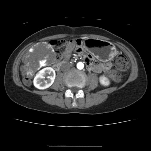 Cavernous hepatic hemangioma (Radiopaedia 75441-86667 A 60).jpg