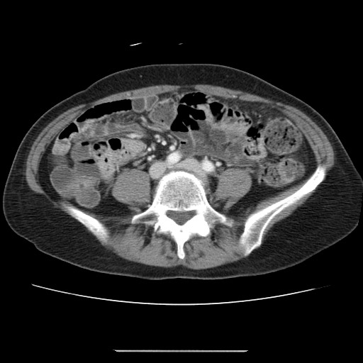 File:Cavernous hepatic hemangioma (Radiopaedia 75441-86667 B 75).jpg