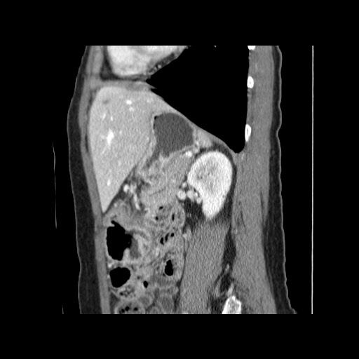 Cavernous hepatic hemangioma (Radiopaedia 75441-86667 D 131).jpg