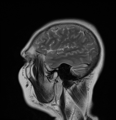 File:Cavernous sinus meningioma (Radiopaedia 63682-72367 Sagittal T2 17).jpg