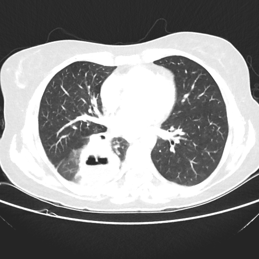 File:Cavitating lung mass - squamous cell carcinoma (Radiopaedia 48047-52854 Axial lung window 28).png