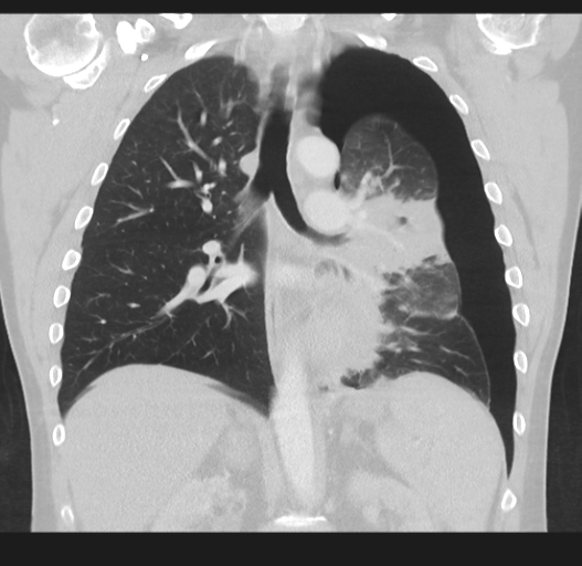Cavitating pneumonia complicated by pneumothorax (Radiopaedia 48149-52994 Coronal lung window 34).png