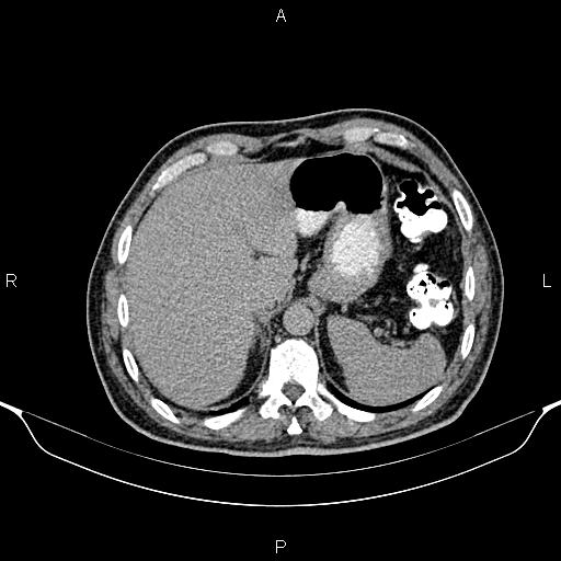 Cecal adenocarcinoma (Radiopaedia 85324-100916 Axial C+ delayed 19).jpg
