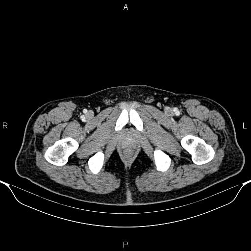Cecal adenocarcinoma (Radiopaedia 85324-100916 B 104).jpg