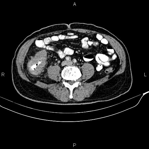 File:Cecal cancer with appendiceal mucocele (Radiopaedia 91080-108651 B 66).jpg
