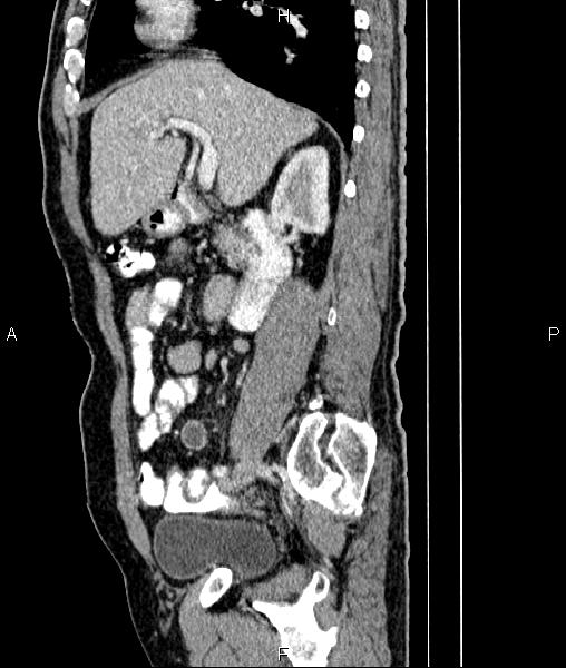 File:Cecal cancer with appendiceal mucocele (Radiopaedia 91080-108651 E 36).jpg