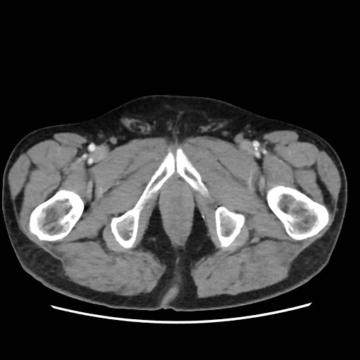 Cecal mass causing appendicitis (Radiopaedia 59207-66531 A 92).jpg