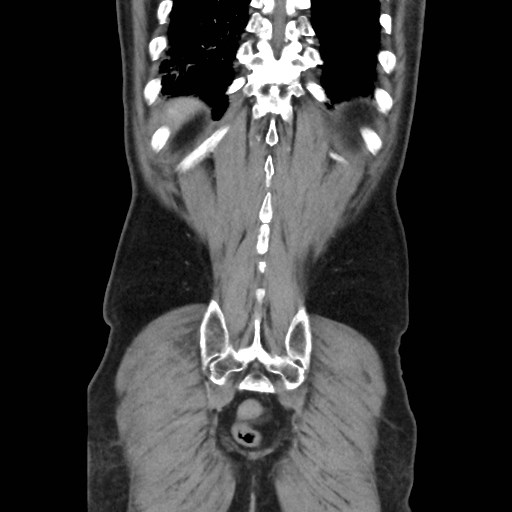 Cecal mass causing appendicitis (Radiopaedia 59207-66531 B 46).jpg