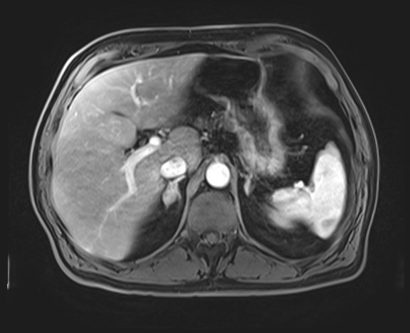 Cecal mass causing appendicitis (Radiopaedia 59207-66532 H 40).jpg