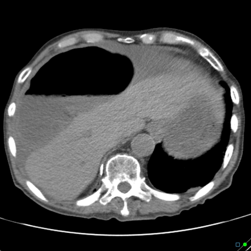 Cecal volvulus - atypical (Radiopaedia 21637-21588 non-contrast 11).jpg