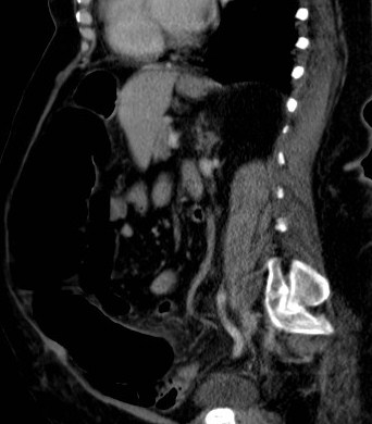 File:Celiac artery compression syndrome (Radiopaedia 24287-24570 A 8).jpg