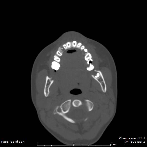 File:Central giant cell granuloma (Radiopaedia 45612-49754 Axial bone window 34).jpg