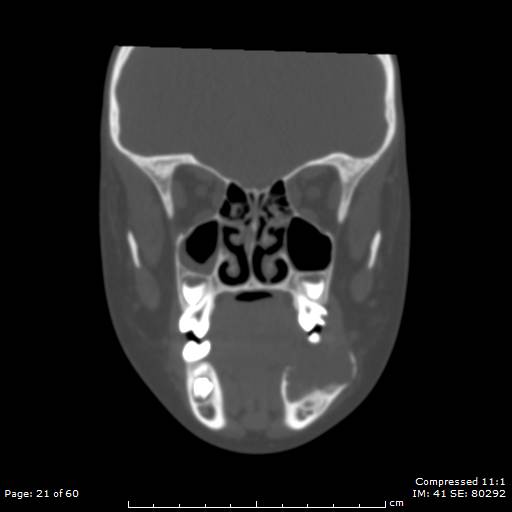 File:Central giant cell granuloma (Radiopaedia 45612-49754 Coronal bone window 21).jpg
