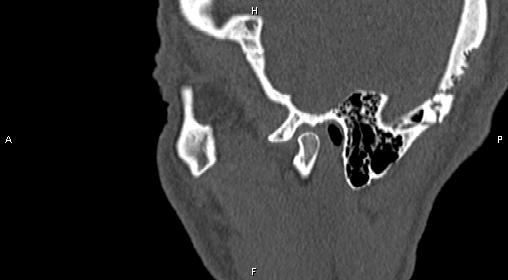 File:Central giant cell granuloma (Radiopaedia 83346-97761 Sagittal bone window 43).jpg