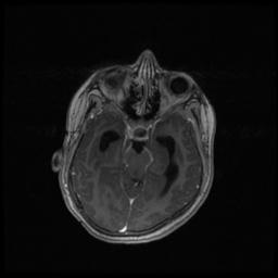 Central neurocytoma (Radiopaedia 30220-30842 Axial T1 C+ 54).jpg