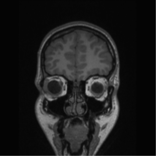 Central neurocytoma (Radiopaedia 37664-39557 Coronal T1 75).png