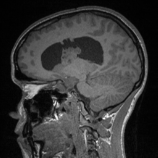Central neurocytoma (Radiopaedia 37664-39557 Sagittal T1 41).png