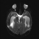 Central neurocytoma (Radiopaedia 56690-63469 Axial DWI 6).jpg