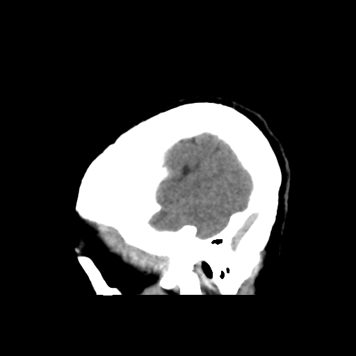 File:Central neurocytoma (Radiopaedia 65317-74346 C 46).png