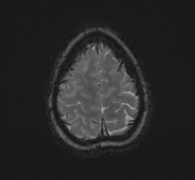 Central neurocytoma (Radiopaedia 70263-80336 Axial SWI 53).jpg