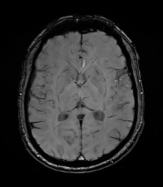 Central neurocytoma (Radiopaedia 71068-81303 Axial SWI 33).jpg